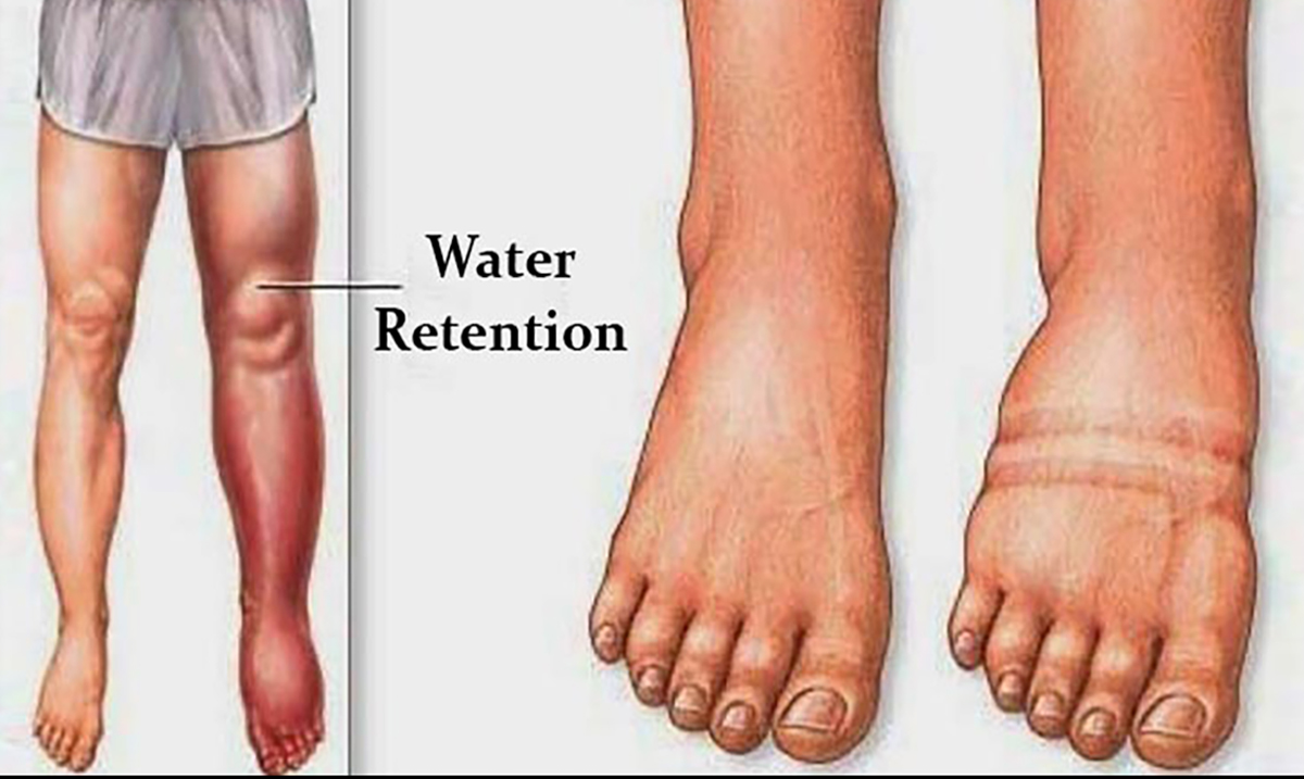 Identifying and Preventing the Causes of Water Retention