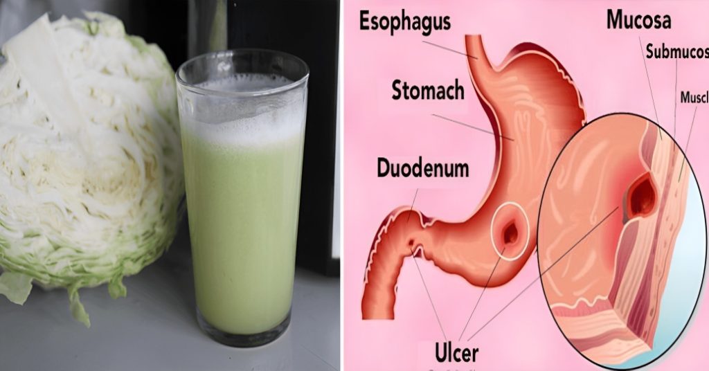 Cabbage juice to heal stomach ulcers and open sores